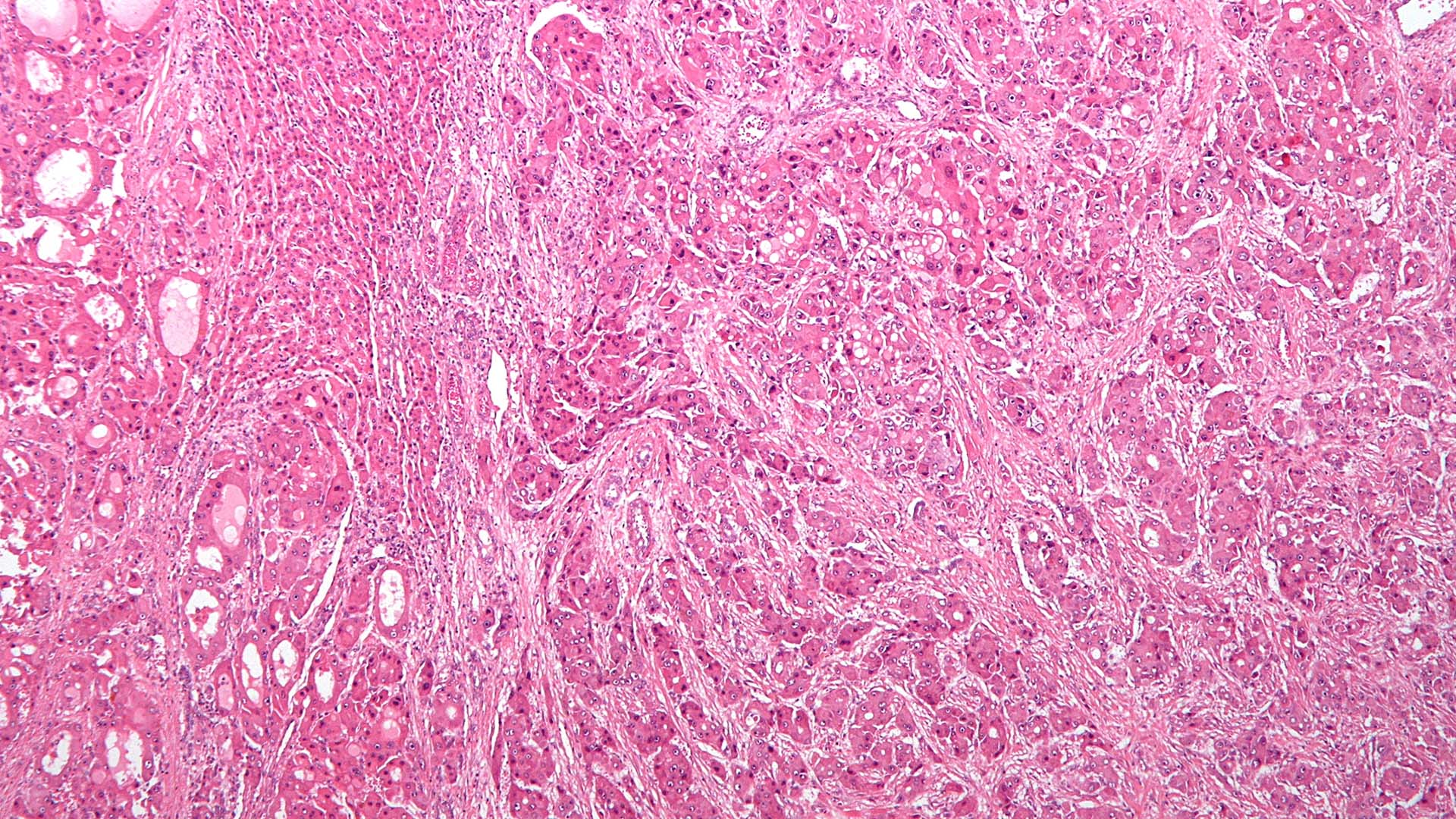 magnification of fibrolamellar hepatocellular carcinoma